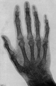 X-rayed hand of Lord Kelvin