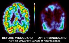PET scan of brain before and after MindGuard